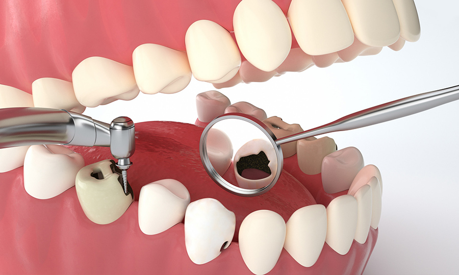 牙齿修复